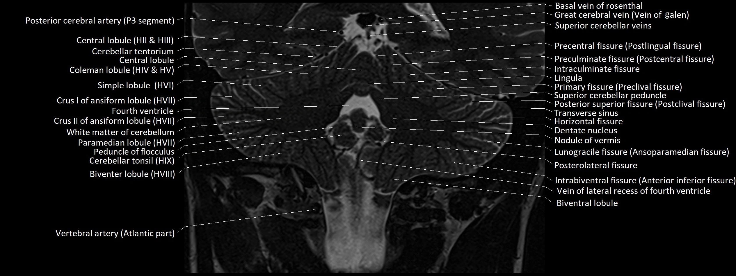 Anatomy of cerebellum coronal cross sectional 3T image 10.webp